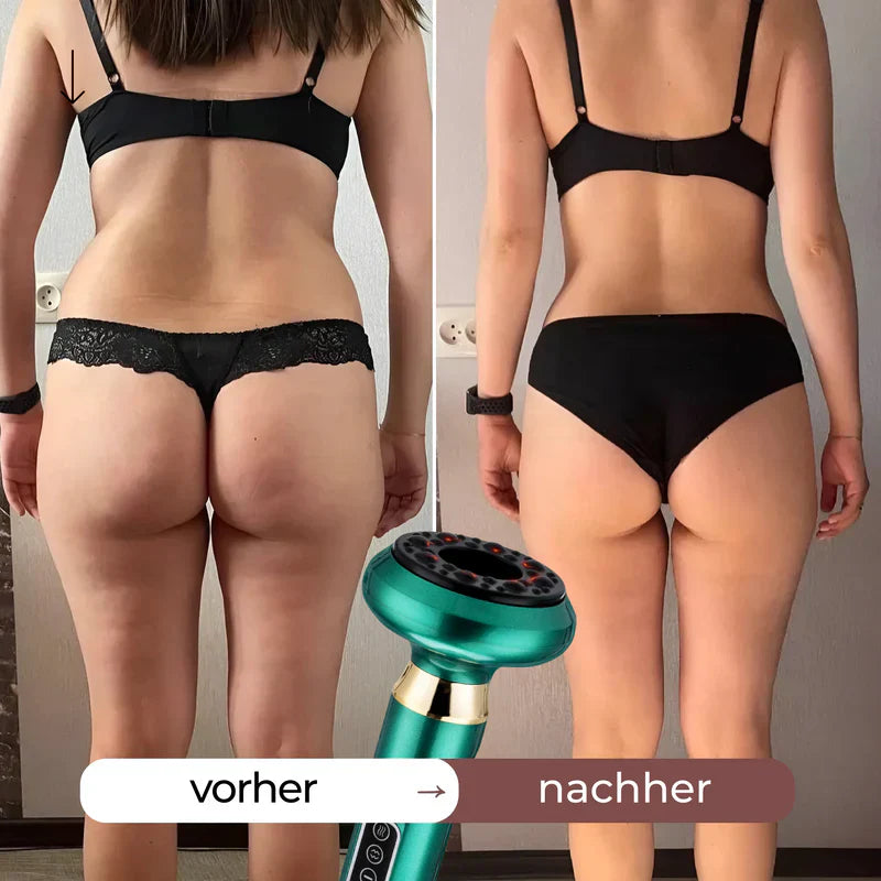 CelluSculpt™ | 4-in-1 Massagegerät mit Schröpfen, Infrarot & Wärme – reduziert Cellulite und Dehnungsstreifen sichtbar