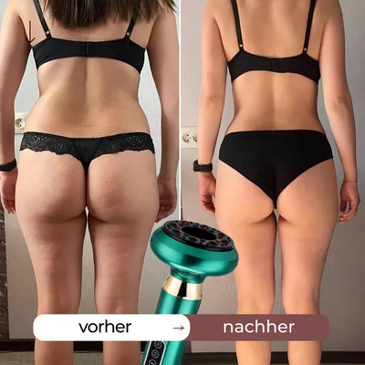 CelluSculpt™ | 4-in-1 Massagegerät mit Schröpfen, Infrarot & Wärme – reduziert Cellulite und Dehnungsstreifen sichtbar