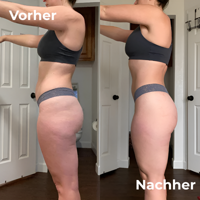 SkinRoll - Cellulite-Roller – klarer Bezug zur Haut